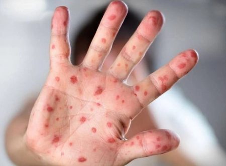 ಎಚ್ಚರ: ಪುರುಷ–ಪುರುಷ ಸೆಕ್ಸ್ ಮಾಡಿದ್ರೆ ಬರುತ್ತಂತೆ ಮಂಕಿಪಾಕ್ಸ್..!! ವಿಶ್ವ ಆರೋಗ್ಯ ಸಂಸ್ಥೆ