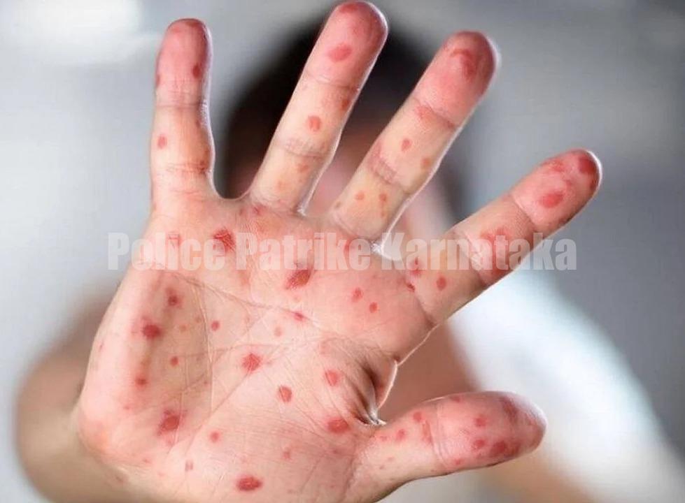 ಎಚ್ಚರ: ಪುರುಷ–ಪುರುಷ ಸೆಕ್ಸ್ ಮಾಡಿದ್ರೆ ಬರುತ್ತಂತೆ ಮಂಕಿಪಾಕ್ಸ್..!! ವಿಶ್ವ ಆರೋಗ್ಯ ಸಂಸ್ಥೆ