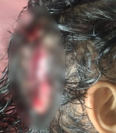 ಮಣಿಪಾಲ ಬೀದಿ ನಾಯಿಗಳ ದಾಳಿ- ಗಾಯಗೊಂಡ ವಿದ್ಯಾರ್ಥಿನಿ ಆಸ್ಪತ್ರೆಗೆ ದಾಖಲು!