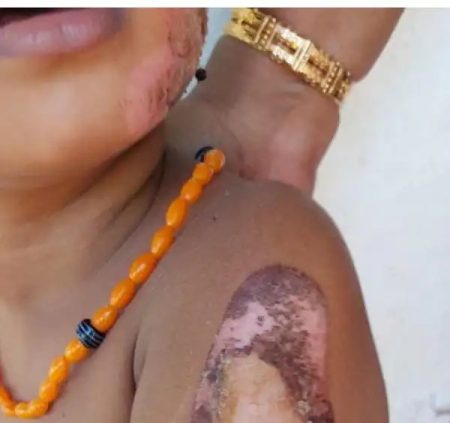 ಸುಳ್ಯ : ಹಠ ಮಾಡುತ್ತಿದ್ದ ಮಗುವಿಗೆ ಬಿಸಿ ಸಟ್ಟುಗದಲ್ಲಿ ಬರೆ ಹಾಕಿದ ತಾಯಿ!