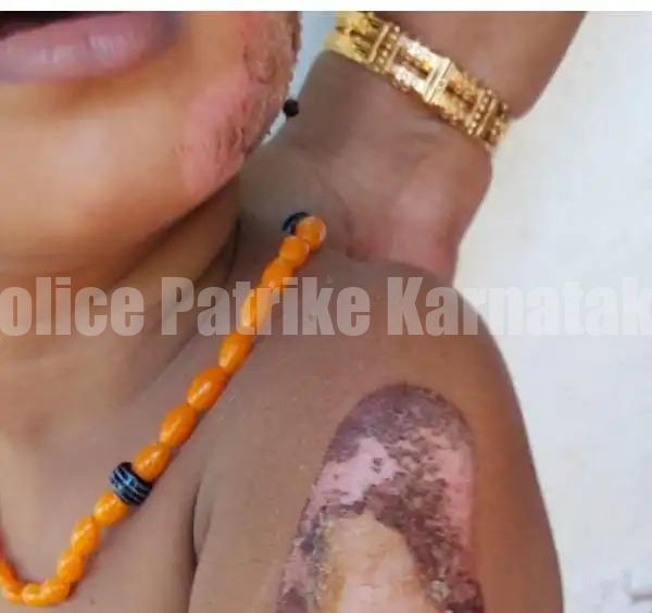 ಸುಳ್ಯ : ಹಠ ಮಾಡುತ್ತಿದ್ದ ಮಗುವಿಗೆ ಬಿಸಿ ಸಟ್ಟುಗದಲ್ಲಿ ಬರೆ ಹಾಕಿದ ತಾಯಿ!