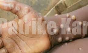 BIG NEWS ಹೆಚ್ಚುತ್ತಿರುವ ಮಂಕಿಪಾಕ್ಸ್-ಕೇಂದ್ರದಿಂದ ಮಾರ್ಗಸೂಚಿ ಬಿಡುಗಡೆ