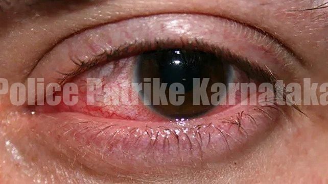 ಮಂಗಳೂರು: ‘ಕೆಂಗಣ್ಣು ಸಮಸ್ಯೆ’ ಹೆಚ್ಚಳ : ವಿದ್ಯಾರ್ಥಿಗಳಿಗೆ ಶಾಲೆ-ಕಾಲೇಜಿಗೆ ಬಾರದಂತೆ ಎಚ್ಚರಿಕೆ