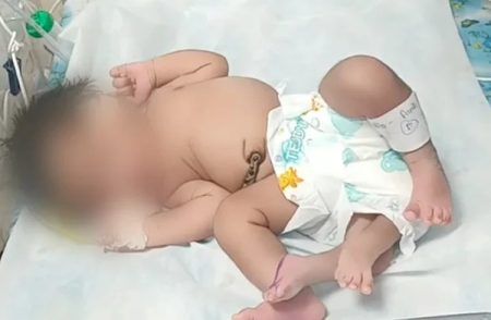 ಮಧ್ಯಪ್ರದೇಶ: ʻನಾಲ್ಕು ಕಾಲುʼಗಳೊಂದಿಗೆ ಹೆಣ್ಣು ಮಗು ಜನನ