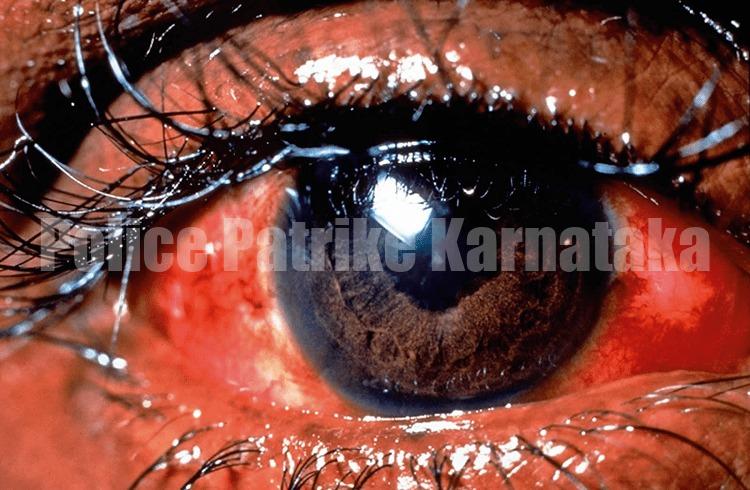 ಉಡುಪಿ ಶಾಲಾ ಮಕ್ಕಳಲ್ಲಿ ಕಾಂಜಂಕ್ಟಿವಿಟಿಸ್ ಕಾಯಿಲೆ ಹೆಚ್ಚಳ – ಮುನ್ನೆಚ್ಚರಿಕೆ ವಹಿಸುವಂತೆ ಸಾರ್ವಜನಿಕರಿಗೆ ಸೂಚನೆ