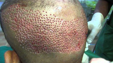 ಕೂದಲು ಶಸ್ತ್ರ ಚಿಕಿತ್ಸೆಗೆ ಹೋದ ವ್ಯಕ್ತಿ ಸಾವು-ಇಬ್ಬರು ವೈದ್ಯರು ಸೇರಿ ನಾಲ್ವರ ಬಂಧನ