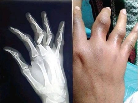 ಕಾರವಾರ: ಪೊಲೀಸರ ಏಟಿಗೆ ಕೈಬೆರಳು ಮುರಿದುಕೊಂಡ ಯುವಕ