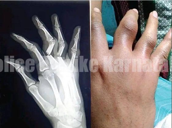 ಕಾರವಾರ: ಪೊಲೀಸರ ಏಟಿಗೆ ಕೈಬೆರಳು ಮುರಿದುಕೊಂಡ ಯುವಕ