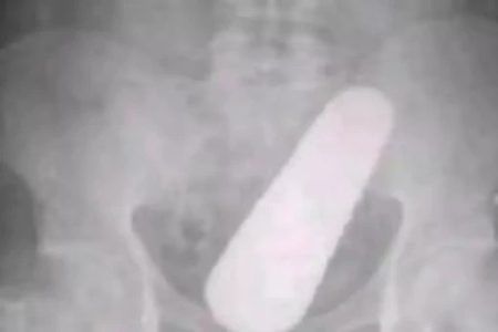 SHOCKING: ಗುದನಾಳದಲ್ಲಿ ಸಿಕ್ಕಿಬಿದ್ದ ಸೌತೆಕಾಯಿ…! ಮುಂದೇನಾಯ್ತು ನೀವೇ ನೋಡಿ