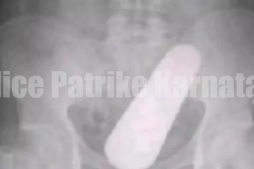 SHOCKING: ಗುದನಾಳದಲ್ಲಿ ಸಿಕ್ಕಿಬಿದ್ದ ಸೌತೆಕಾಯಿ…! ಮುಂದೇನಾಯ್ತು ನೀವೇ ನೋಡಿ