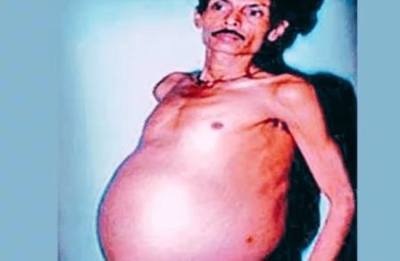 SHOCKING: 36 ವರ್ಷಗಳ ಕಾಲ ಗರ್ಭಿಣಿಯಾಗಿದ್ದ ವ್ಯಕ್ತಿಗೆ ಅವಳಿ ಮಕ್ಕಳ ಜನನ, ವೈದ್ಯ ಲೋಕವೇ ಶಾಕ್