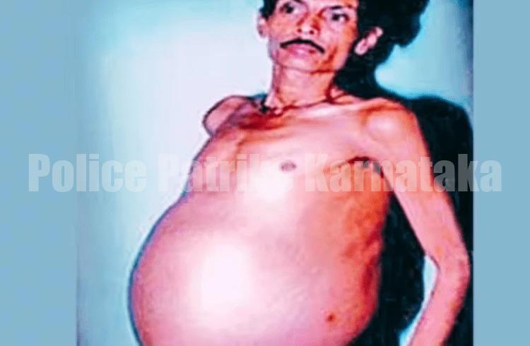 SHOCKING: 36 ವರ್ಷಗಳ ಕಾಲ ಗರ್ಭಿಣಿಯಾಗಿದ್ದ ವ್ಯಕ್ತಿಗೆ ಅವಳಿ ಮಕ್ಕಳ ಜನನ, ವೈದ್ಯ ಲೋಕವೇ ಶಾಕ್