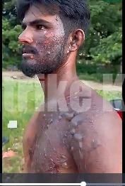 ಉಡುಪಿ: ಪತಿಗೆ ಮೆಣಸಿನ ಹುಡಿ ಮಿಶ್ರಿತ ಬಿಸಿ ನೀರು ಎರಚಿದ ಪತ್ನಿ!