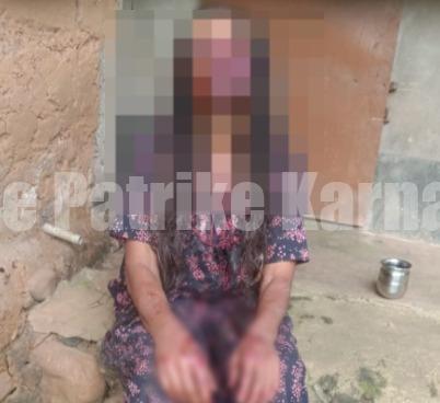 ಬೆಳ್ತಂಗಡಿ: ಮದ್ಯದ ಮತ್ತಿನಲ್ಲಿ ಹಲ್ಲೆಗೈದು ಪತ್ನಿಯ ಕಣ್ಣು, ಕೆನ್ನೆ ಕಚ್ಚಿ ಮಾಂಸವನ್ನೇ ಕಿತ್ತು ಹಾಕಿದ ಕಟುಕ ಪತಿ