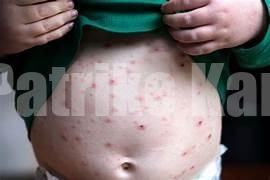 ದಕ್ಷಿಣ ಕನ್ನಡ ಜಿಲ್ಲೆಯ ಹಲವೆಡೆ ಚಿಕನ್ ಪಾಕ್ಸ್ ಆತಂಕ; ಕಡಬ ತಾಲೂಕಿನಲ್ಲೇ 21 ಪ್ರಕರಣ