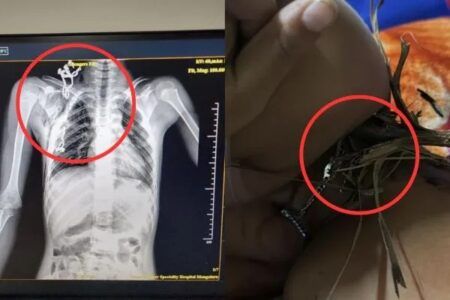 ಮಂಗಳೂರು: ಬಾಲಕನ ಎದೆಯಿಂದ ತೆಂಗಿನ ಗರಿಯನ್ನು ಹೊರ ತೆಗೆದ ವೆನ್ಲಾಕ್ ಆಸ್ಪತ್ರೆಯ ವೈದ್ಯರು..!