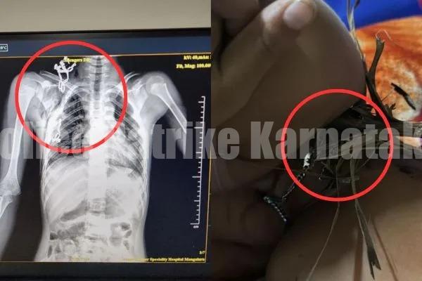 ಮಂಗಳೂರು: ಬಾಲಕನ ಎದೆಯಿಂದ ತೆಂಗಿನ ಗರಿಯನ್ನು ಹೊರ ತೆಗೆದ ವೆನ್ಲಾಕ್ ಆಸ್ಪತ್ರೆಯ ವೈದ್ಯರು..!