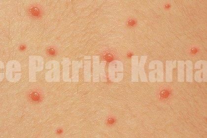 ದ.ಕ ಜಿಲ್ಲೆಯಲ್ಲಿ ಚಿಕನ್ ಪಾಕ್ಸ್ ಪ್ರಕರಣ ಹೆಚ್ಚಳ..!! ಮುನ್ನೆಚ್ಚರಿಕೆ ವಹಿಸಲು ಸೂಚನೆ