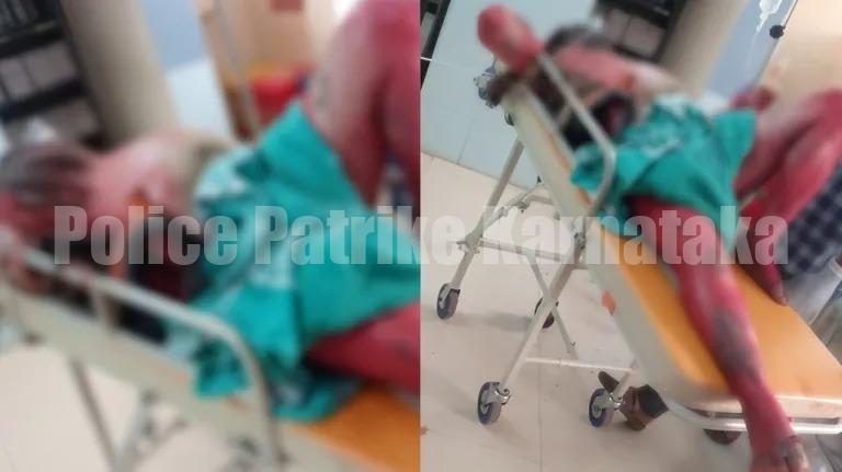 ಬೆಳ್ತಂಗಡಿ: ಪೆಟ್ರೋಲ್ ಸುರಿದು ಬೆಂಕಿ ಹಚ್ಚಿಕೊಂಡು ಆತ್ಮಹತ್ಯೆಗೆ ಯತ್ನ..!!